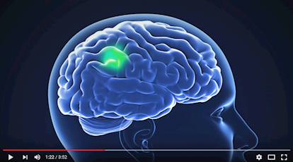 Gateway-Funded Pediatric Brain Cancer Clinical Trial